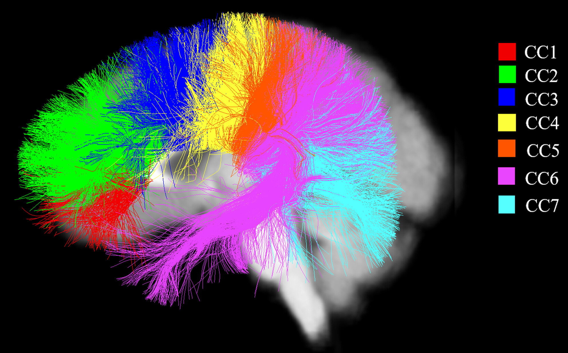 Free Water Corrected Diffusion Magnetic Resonance Imaging Reveals Microstructural Alterations in Corpus Callosum Subregions of Preschool Children With Autism